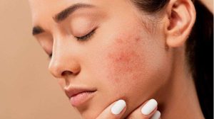 Tips Perawatan Kulit Sensitif agar Tetap Sehat dan Cantik